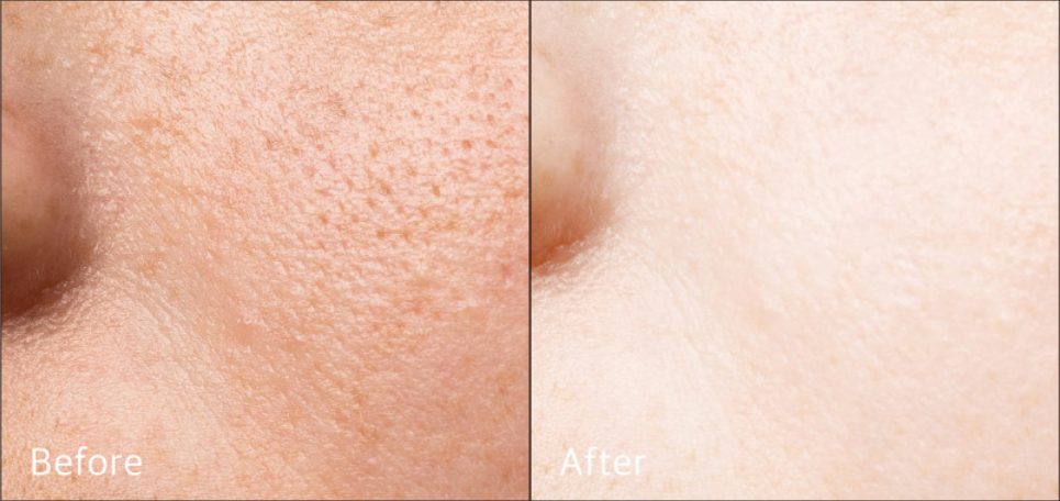 Vegansk toner, ris toner Risvand toner, koreansk ansigtstoner Naturlig toner,toner uden parfume Fugtgivende toner,toner med aloe vera Hyaluronsyre toner, AHA PHA toner Toner til sensitiv hud, opstrammende toner Lysnende toner, porerensende toner Toner mod tør hud Økologisk risvand toner Vegansk hudpleje toner Vegansk K-beauty toner Toner til alle hudtyper Mild ansigtstoner Rense toner til ansigtet Toner mod uren hud Toner mod ru hud Toner uden syntetiske dufte Toner tiltræt hud Toner mod pigmentpletter Koreansk hudpleje til ansigt Vegansk skønhedspleje toner Fugtbooster toner